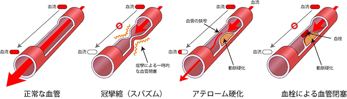 動脈硬化の血管狭い図と血管がけいれんしている図